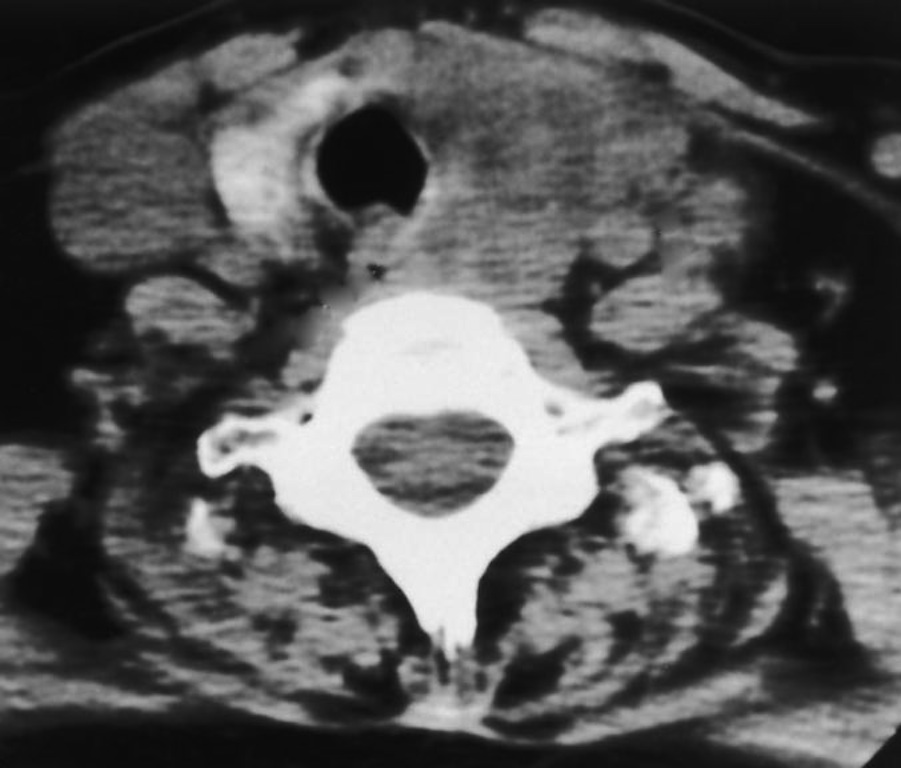 Pathology Outlines Anaplastic Undifferentiated High Grade Carcinoma